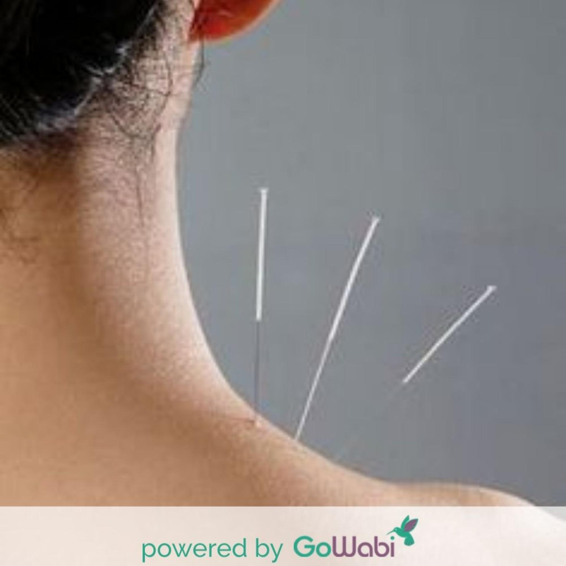 Suankwangtung Clinic - Acupuncture Package: A-E (1 Time)