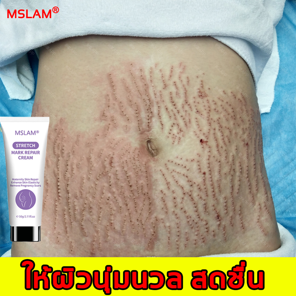 บำรุงผิว MSLAM ครีมลดลอยแตกลาย ปรับสภาพผิว ลดรอยแตกลาย ผิวมีความยืดหยุ่น ครีมทาท้องลาย ลดรอยแตกลาย แก้รอยแตกลาย ครีมแก้ท้องลาย ลดผิวแตกลาย ครีมลดรอยแตกลาย ครีมทาขาแตกลาย แก้แตกลาย ครีมลดรอยแตก ครีมลดผิวแตกลาย ครีมท้องแตกลาย ครีมแก้แตกลาย