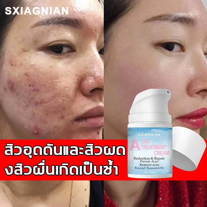 SXIAGNIAN ครีมรักษาสิว กำจัดสิวหายรวดเร็ว ขจัดสิวอุดตันและสิวผด ยับยั้งสิวผื่น เกิดเป็นซ้ำ กำจัดสีว ไม่มีหัว ทำความสะอาดองล้ำลึก ลดอาการสิวบวมแดง (ครีมแต้มสิว,เจลแต้มสิว,ครีมกำจัดสิว,เซรั่มลดสิว,ครีมลดรอยสิว,เจลลดสิว,ครีมบำรุงหน้า) Acne Cream30g