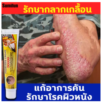 Sumifun (จัดส่งในไทย) ครีมสมุนไพร 100% สำหรับกลาก, สะเก็ดเงิน, ยุงกัด, ติดเชื้อรา, สะเก็ดเงิน, ยาทาผิวหนัง, ยาแก้คัน