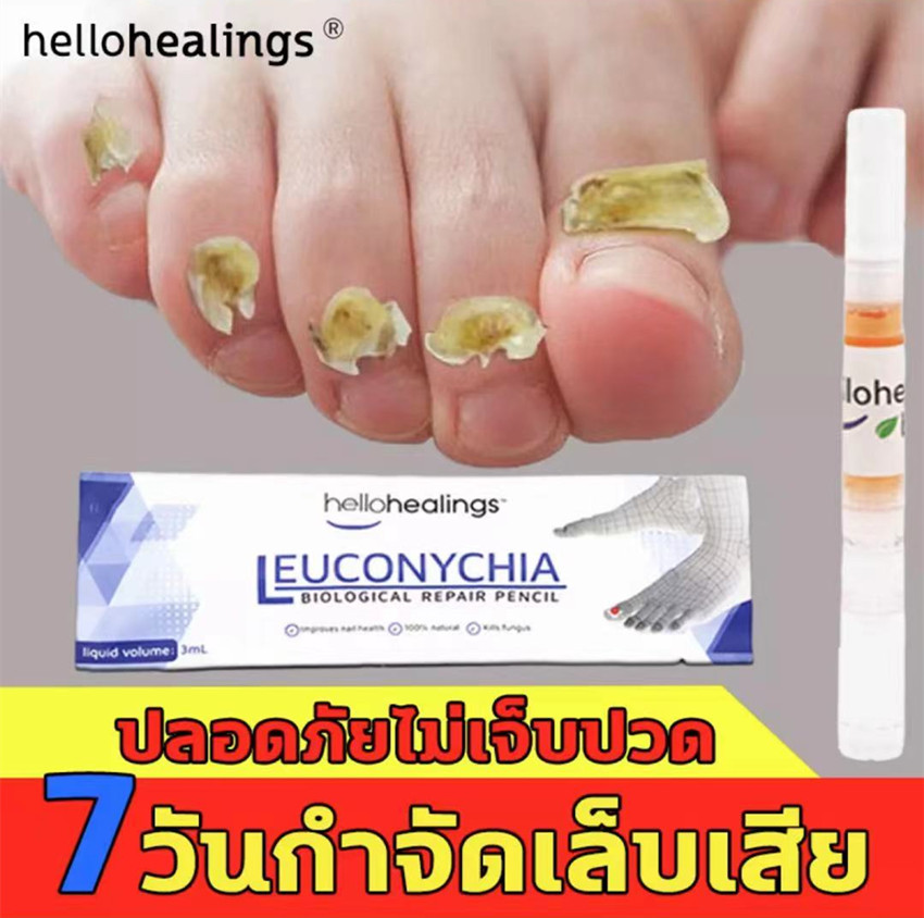 บอกลาปัญหาเล็บต่างๆ Hellohealings 30mlเซรั่มรักษาเล็บ รักษาเล็บ เล็บเท้าคุณภาพสูงกำจัดเชื้อราที่เล็บ เอ็สเซ้นซ่อมแซมเล็บเสีย รักษารคเชื้อราที่เล็บ เล็บพัง เล็บขบ เซรั่มบำรุงเล็บดูแลเล็บ ครีมบำรุ ซ่อมแซมเล็บ น้ำมันบำรุงเล็บ nail care repair