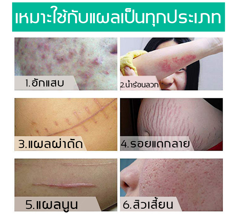 ปรับปรุงรอยแผลเป็น Elaimei ครีมลบแผลเป็น แผลเป็นผ่าตัด แผลไฟไหม้ น้ำร้อนลวก แผลเป็นนูนหนา