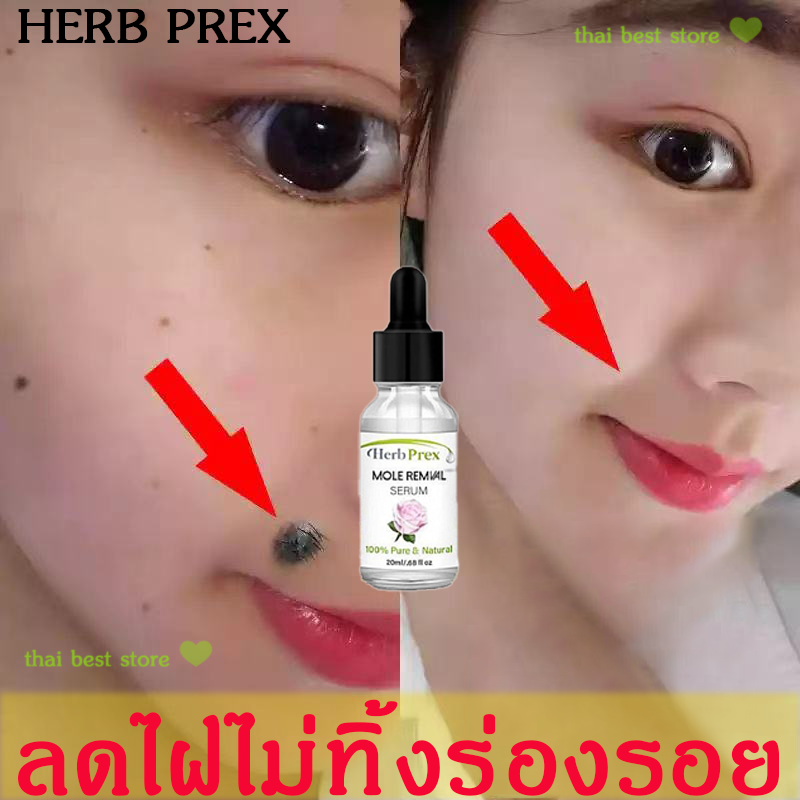 ลดไฝไม่ทิ้งร่องรอย Herb Rpex น้ำยากำจัดไฝ ครีมกำจัดขี้แมลงวัน ปลอดภัย ไม่เจ็บปวด สามารถโดนน้ำได้ (ยาลบขี้แมลงวัน ครีมจี้ไฝ ครีมกำจัดติ่งเนื้อ ครีมแต้มไฝ ครีมไฝ ครีมกำจัดหูด ครีมกำจัดจี้ไฝ ยาจี้ไฝ กำจัดติ่งเนื้อ จี้ไฝ ​ยากำจัดใฝ ยากำจัดไฝ)