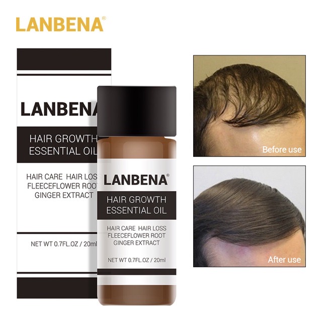 น้ำยาปลูกผม บำรุงรากและเส้นผมให้แข็งแรง(LanBeNa) Hair Growth Essential Oil