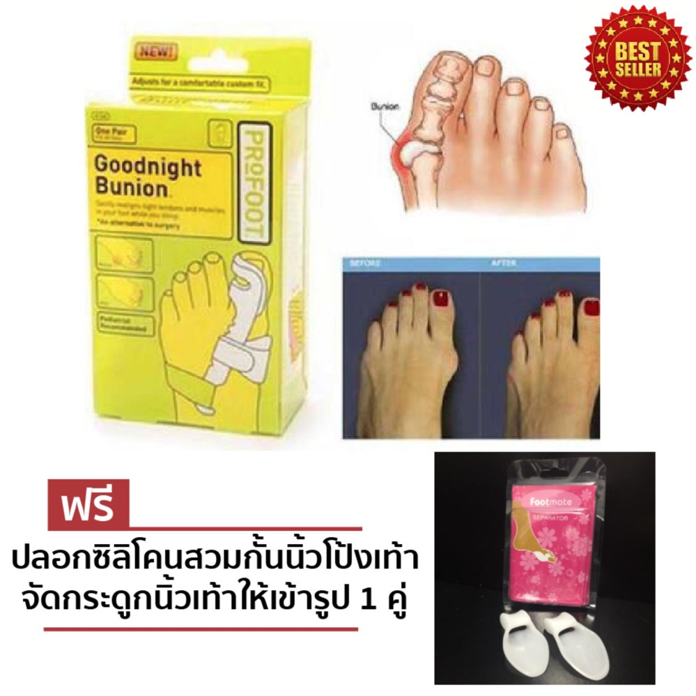 รีวิว LONDON GOODNIGHT BUNION อุปกรณ์เฝือกอ่อนดัดนิ้วโป้งเท้าผิดรูป