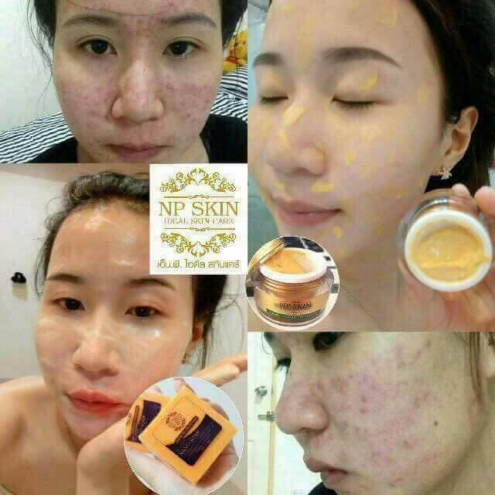 ซื้อที่ไหน NP SKIN คู่จิ้นแก้ปัญหาสิว - Ida New Beauty