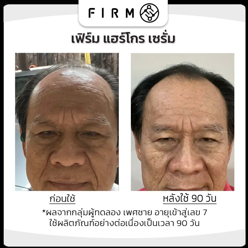 ภาพสินค้า2 กล่อง FIRM Gro Serum (สูตรผู้ชาย) เซรั่มปลูกผม ลดผมร่วง ช่วยลดความมัน ลดการอักเสบ เส้นผมดกดำเงางาม ส่งฟรี จากร้าน FIRM Hair Serum บน Lazada ภาพที่ 3