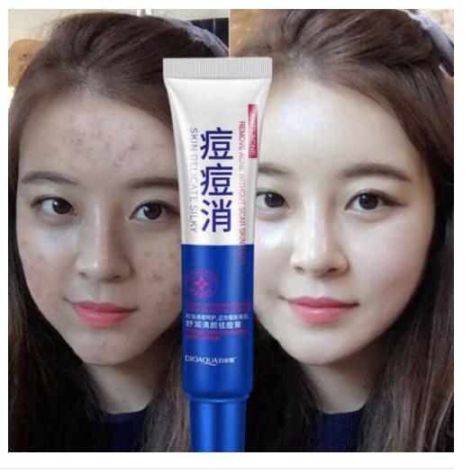 Acne cream สิวBIOAQUA ครีมรักษาแผลเป็น เครื่องสำอางสำหรับผู้ที่เป็นสิว acne scar cream Korea style สวยเร่งด่วน ควบคุมน้ำมัน ช่อมแชมและดูแล