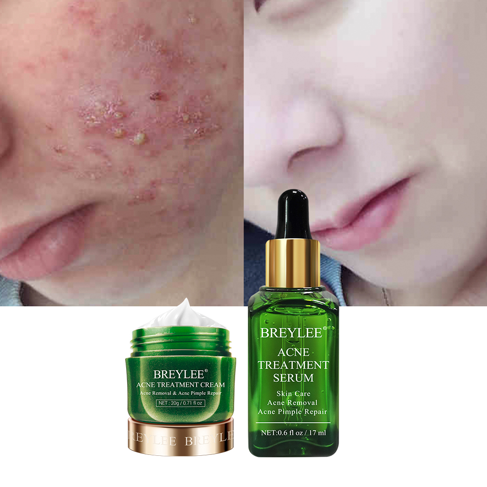 pimple solution cream