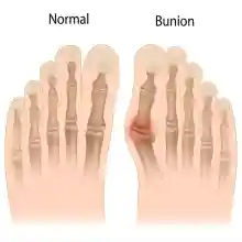 ภาพขนาดย่อของภาพหน้าปกสินค้าอุปกรณ์ดัดนิ้วเท้า Hallux valgus ราคาต่อ1คู่ (2ข้าง) ดัดกระดูกนิ้วโป้งเท้ายื่น นิ้วหัวแม่เท้าเอียง โปน คด Bunion corrector อุปกรณ์สามารถโค้งงอตรงข้อ จากร้าน Cheapcheerful บน Lazada ภาพที่ 7