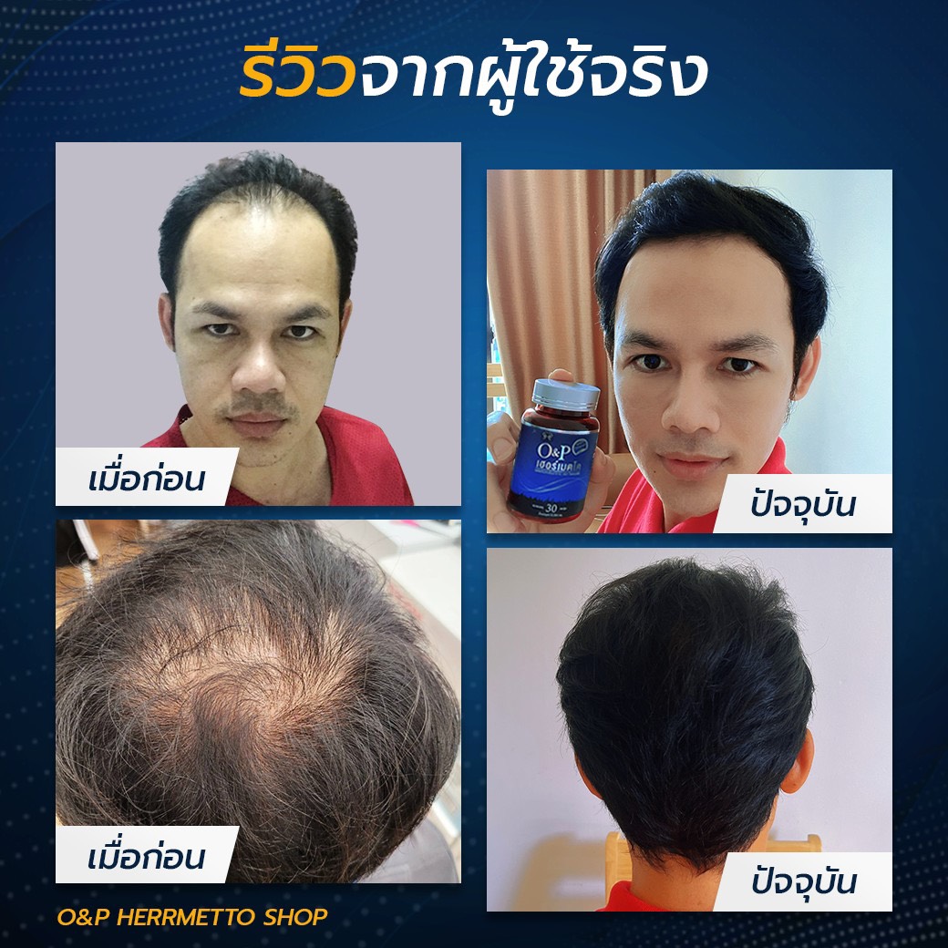 Herrmettoอาหารเสริมเพื่อเส้นผม ผู้ชาย ผมร่วง ผมบาง ของแท้100 จำนวน 2 