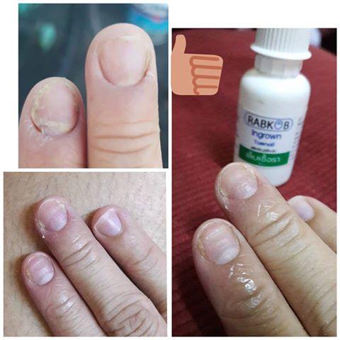 (ส่งฟรี) เล็บเชื้อรา หายได้ด้วยสมุนไพร 7ชนิด  Fungus nail 1หลอด 14cc สูตรสีเขียว ทำเล็บ เล็บขบ เล็บเจล สีทาเล็บ สปาเล็บ กรรไกรตัดเล็บ