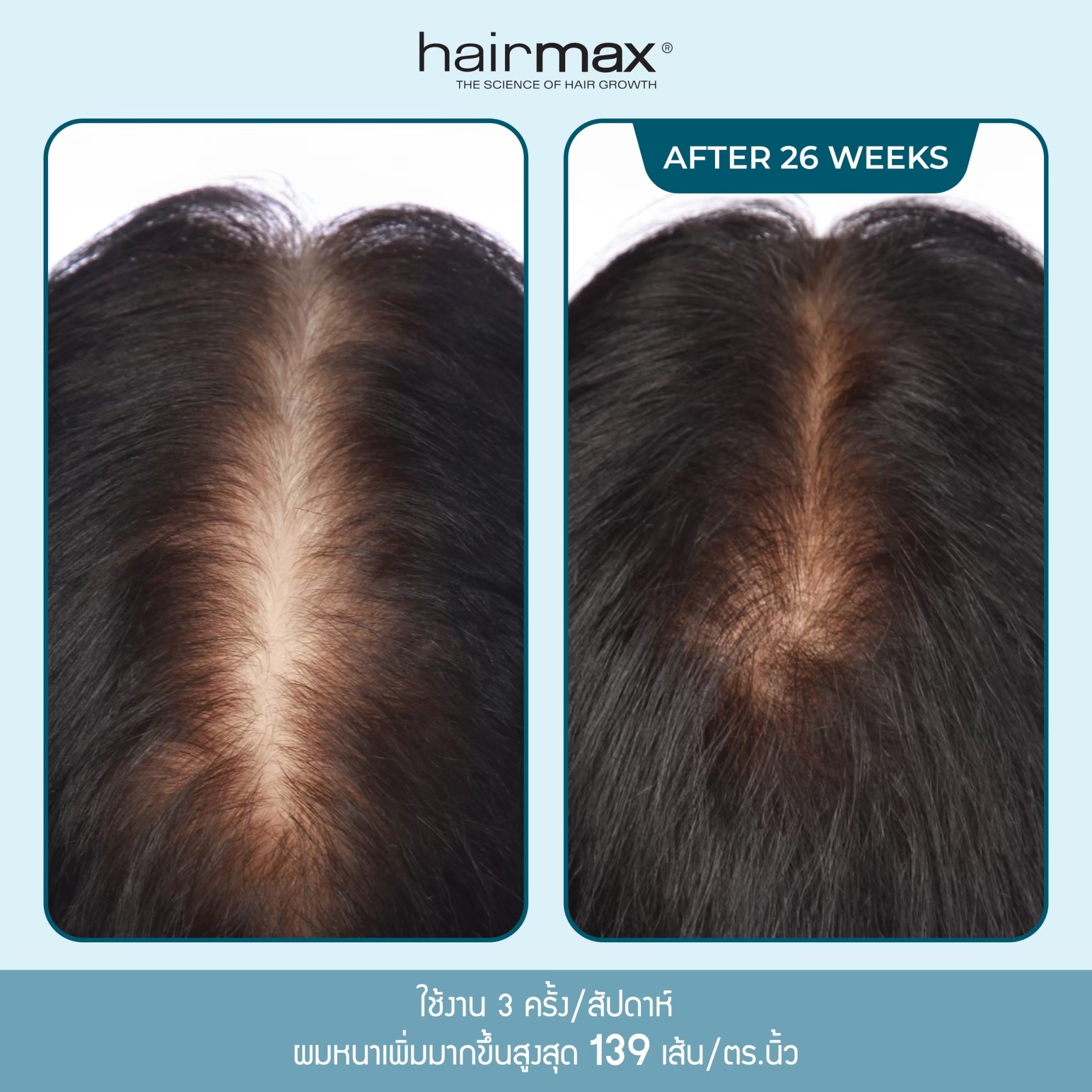 Hairmax Hair Growth Laser Band (FDA Cleared), LaserBand 82 ComfortFlex,  Full/Partial Coverage, Hair Growth for Men & Hair Regrowth for Women, Hair  Laser Growth, (100% Medical Grade Lasers, Not LEDs)