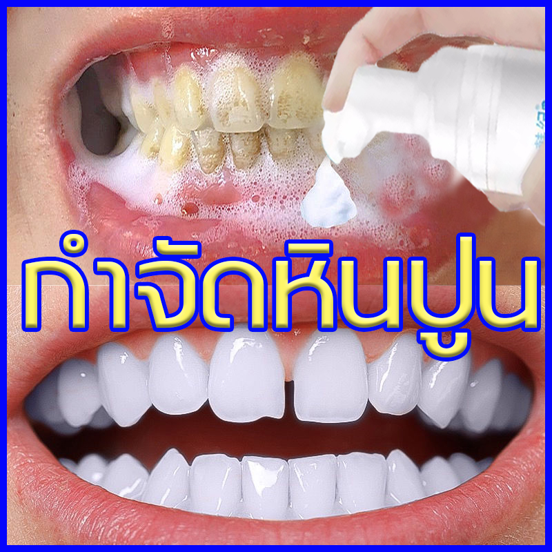 กำจัดฟันเหลืองและกลิ่นปากได้อย่างมีประสิทธิภาพ HANKEY ฟอกฟันขาว（ฟอกฟันขาว ยาสีฟันฟอกฟันขาว น้ำยาฟอกฟันขาว ขจับครบเหลืองลดกลิ่นปาก เซรั่มฟอกฟัน ยาสีฟันไวท์เทนนิ่ง ลดกลิ่นปาก แก้ฟันเหลือง มูสแปรงฟัน ยาสีฟันฟันขาว ฟันเหลือง ฟอกฟันขาว แคลคูลัสทันตกรรม）