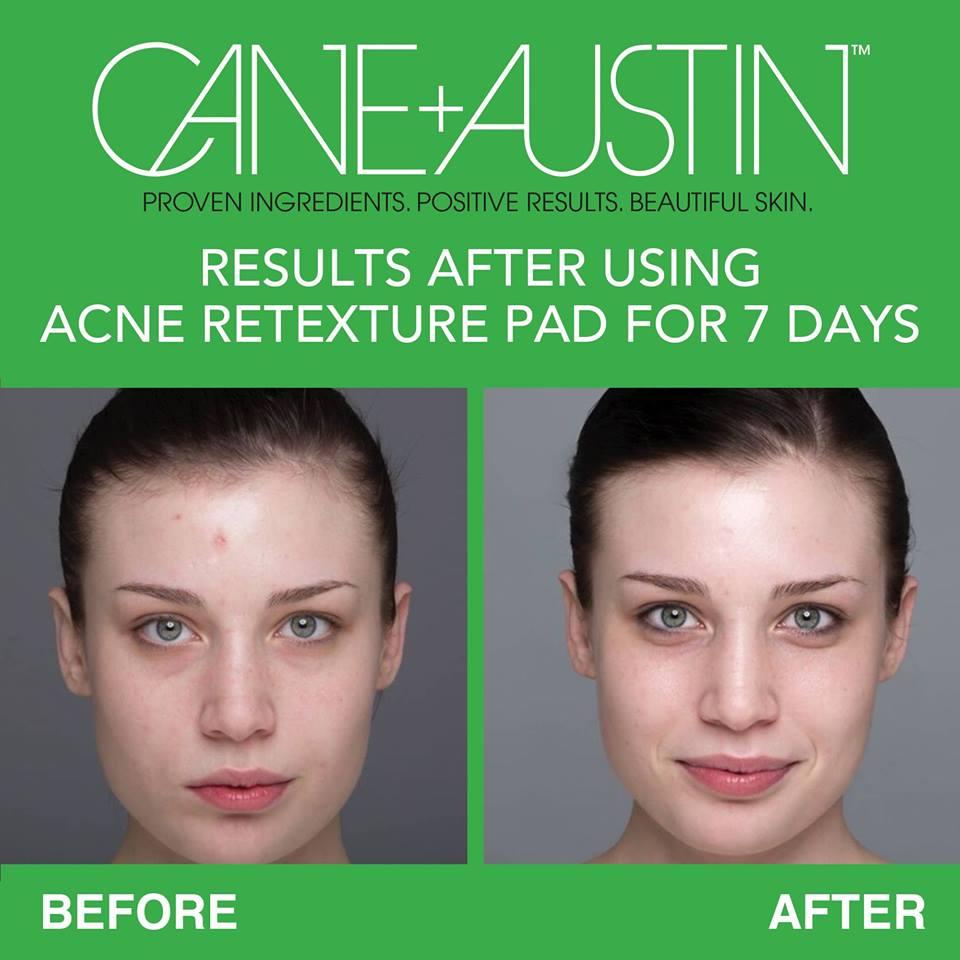 CANE+AUSTIN Acne Retexture Pad 2 Salicylic Acid with 5 Glycolic Acid