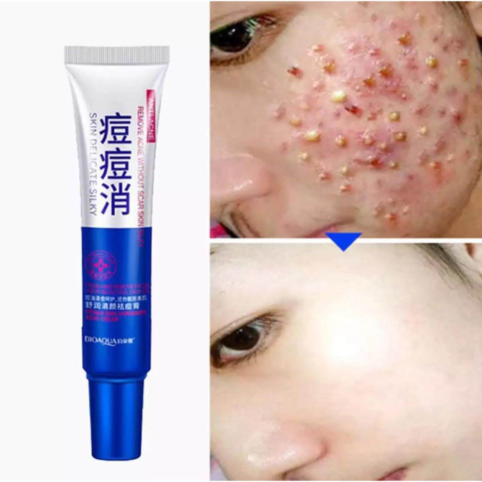 BIOAQUA Acne cream ครีมรักษาสิว ครีมแต้มสิว เจลรักษาสิว ครีมลบสิว ครีมรักษารอยสิวรอยแดง เครื่องสำอางสำหรับผู้ที่เป็นสิว สวยเร่งด่วน ช่อมแชมและดูแลผิว acne scar cream Korea style an-ti acne