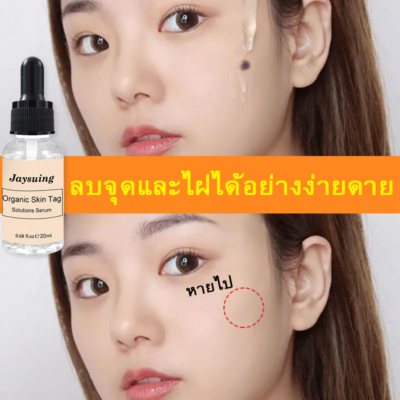 ยากำจัดไฝ30ml กำจัดไฝ ครีมจี้ไฝ กำจัดติ่งเนื้อ ไฝไม่ทิ้งร่องรอย ปลอดภัย ไม่เจ็บปวด ลดไฝลด ครีมกําจัดไฝ ตาปลากระปานเล็กจุดด่างดำหลุ