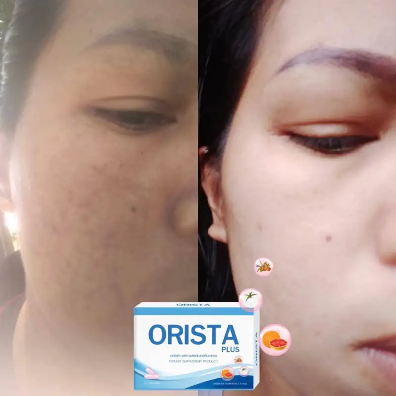 ภาพสินค้าโปร 3แถม2 ฟรี ทรีทเมนท์ : Orista Plus (ออริสต้า พลัส) วิตามินรักษาฝ้ากระ ยับยั้งการเกิดฝ้าใหม่ และช่วยลดริ้วรอย ปรับผิวขาวใส / ออริสต้า จากร้าน NAPAT COSME บน Lazada ภาพที่ 7