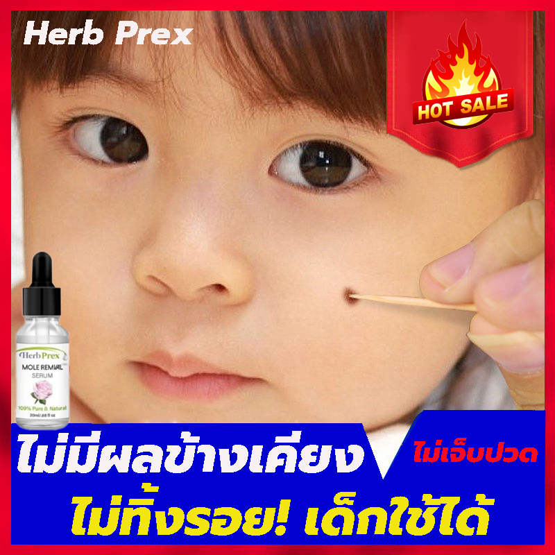 ของแท้ ได้ผลเร็ว！!HERB PREXกำจัด ยากำจัดไฝ  ไฝไม่ทิ้งร่องรอย ปลอดภัย（แต้มไฝ น้ำยาจี้ไฝ ครีมลบไฝ ยาลบขี้แมลงวัน ครีมจี้ไฝ ครีมกำจัดติ่งเนื้อ ครีมแต้มไฝ ครีมไฝ ครีมกำจัดหูด ครีมกำจัดจี้ไฝ ยาจี้ไฝ กำจัดติ่งเนื้อ จี้ไฝ ยากำจัดใฝ ยากำจัดไฝ）Mole removal