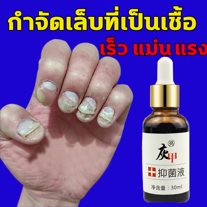 {ของขวัญฟรี} เซรั่มทาเล็บ น้ำมันบำรุงเล็บ น้ำเซรั่มบำรุงเล็บ กำจัดเชื้อราที่เล็บ เซรั่มหยอดเล็บขบ ต้านเชื้อแบคทีเรีย เล็บหลุดลอก เล็บเปิด เล็บพัง เล็บขบ กำจัดโรคเชื้อราที่เล็บ ครีมบำรุงซ่อมแซมเล็บ เซรั่มกำจัดเล็บพัง Nails Repair care