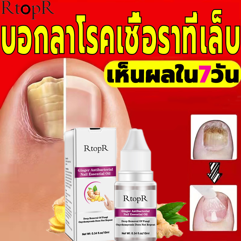 【เห็นผลภายใน7วัน 】RTOPR รักษาเล็บ เล็บเท้าคุณภาพสูงกำจัดเชื้อราที่เล็บ เอ็สเซ้นซ่อมแซมเล็บเสีย รักษารคเชื้อราที่เล็บ เล็บพัง เล็บขบ เซรั่มบำรุงเล็บ น้ำมันบำรุงเล็บ ดูแลเล็บ(เชื้อราเล็บมือ น้ำยารักษาเล็บ เซรั่มเล็บ ยาเชื้อราเล็บ บำรุงเล็บน้ำมันบำรุงเล็บ）