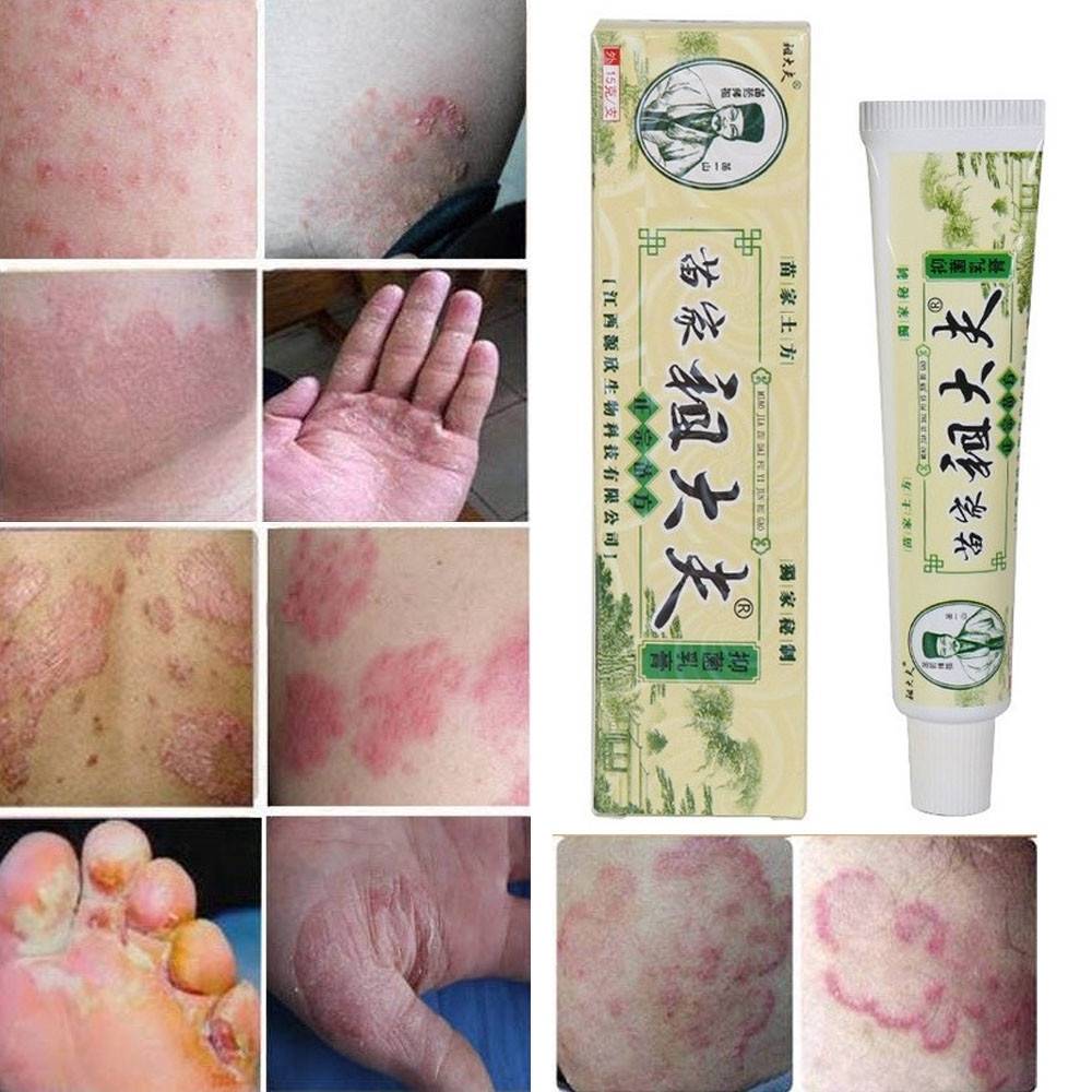 ครีมสมุนไพร สำหรับกลากเกลื้อน โรคสะเก็ดเงิน โรคน้ำกัดเท้า  ผื่นคัน Body Psoriasis Pruritus Eczema Dermatitis Cream 15g Safety Natural Effects Suitable All Skin