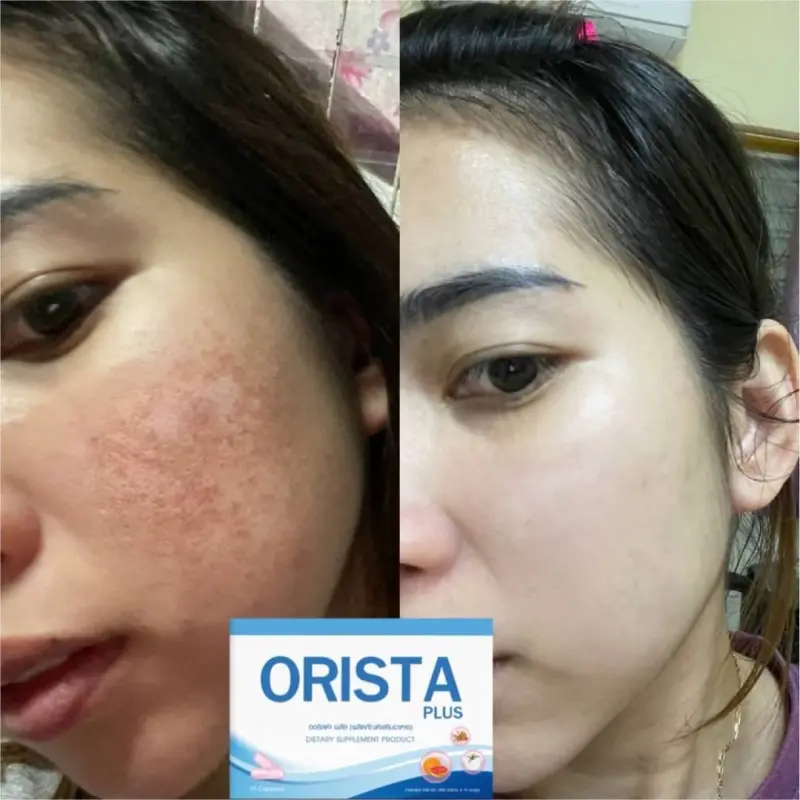 ภาพสินค้าโปร 3แถม2 ฟรี ทรีทเมนท์ : Orista Plus (ออริสต้า พลัส) วิตามินรักษาฝ้ากระ ยับยั้งการเกิดฝ้าใหม่ และช่วยลดริ้วรอย ปรับผิวขาวใส / ออริสต้า จากร้าน NAPAT COSME บน Lazada ภาพที่ 6