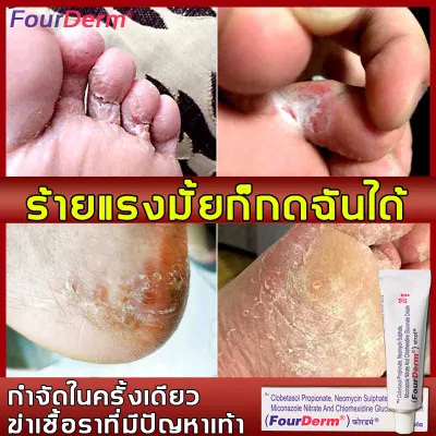 เกรดทางแพทย์ อินเดียFourDerm ครีมลดกลิ่นเท้า ฆ่าเชื้อราที่เท้า แก้ปัญหาจากต้นทาง ใช้สำหรับอาการคันเท้า กลิ่นเท้า ลอกเท้า แผลพุพองและปัญหาเท้าอื่น ๆ ไม่เคยกำเริบ (ครีมติดเชื้อรา,ระงับกลิ่นเท้า,ยาดับกลิ่นเท้า,ยาทาเท้าเหม็น,แก้เท้าเหม็น)