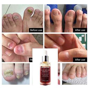 (เซรั่มรักษาเล็บLANBENA)  น้ำมันบำรุงเล็บ รักษาเล็บ เล็บขบ เชื้้อรา สมุนไพรรักษาเล็บขบ Nail Repair Essence Serum Fungal Nail Treatment Remove Onychomycosis Toe Nourishing Brighten Hand Foot Skin Care 12ml