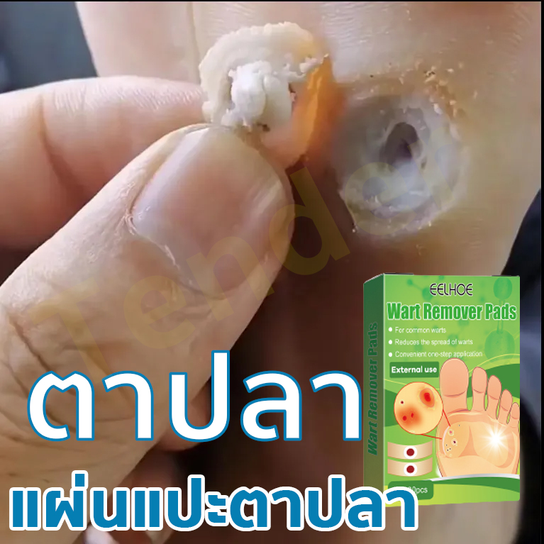 (จัดส่งทันที) แต้มหูดตาปลา ขจัดไฝและติ่งเนื้อ แบบถอนรากถอนโคน Wart