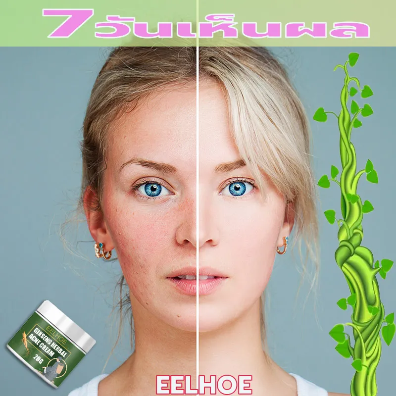 🔥สินค้าขายดีEELHOEรอยดำจากสิว，ภายใน7วัน ไม่ก่อให้เกิดสิว, ผิวหน้าดูเรียบเนียน(ครีมล้างหน้า โฟมล้างหน้า ครีมแต้มสิว เจลรักษาสิว ครีมกำจัดสิว ครีมบำรุงหน้า ครีมหน้าขาวใส ครีมรักษาสิว ครีมแก้ฝ้า เจลแต้มสิว เจลเเต้มสิว แต้มสิวอักเสบ ครีมขจัดใฝ  เจลละลายสิว )
