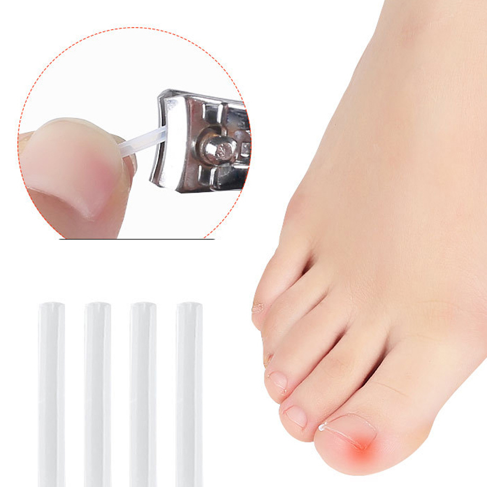 Miếng dán chỉnh hình móng chân mọc ngược WAF2125 - INTL