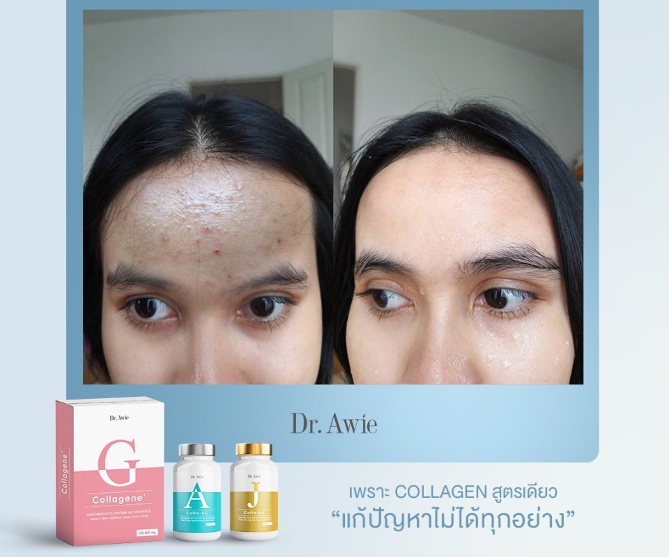 ภาพประกอบของ SET คอลลาเจนลดสิวผิวใส [ของแท้ ส่งฟรี ] Dr.awie Colla-AC คอลาเจนแก้สิว *ของแท้ ส่งฟรี* คอลลาเจนญี่ปุ่น คอลลาเจนลดสิว โดยหมอผึ้ง [ 2 กระปุก 1 กล่อง ]