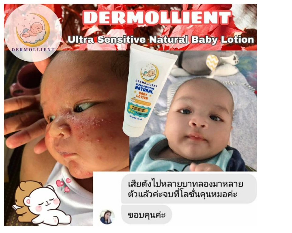 ข้อมูลเพิ่มเติมของ 🌟สูตรหมอ ลดผื่นภูมิแพ้คัน Dermollient Ultra​ Sensitive​ Natural​ Baby​ Lotion​ (150​ กรัม​)