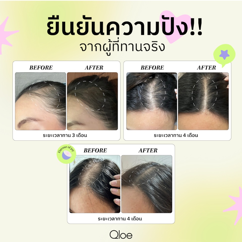 รูปภาพรายละเอียดของ Qloe HSN Gummy กัมมี่บำรุงผมด้วย Biotin สูงถึง 6,000 มก. จำนวน 1 กระปุก (ทานได้ 30 วัน) เหมาะสำหรับผู้ที่เริ่มมีปัญหา