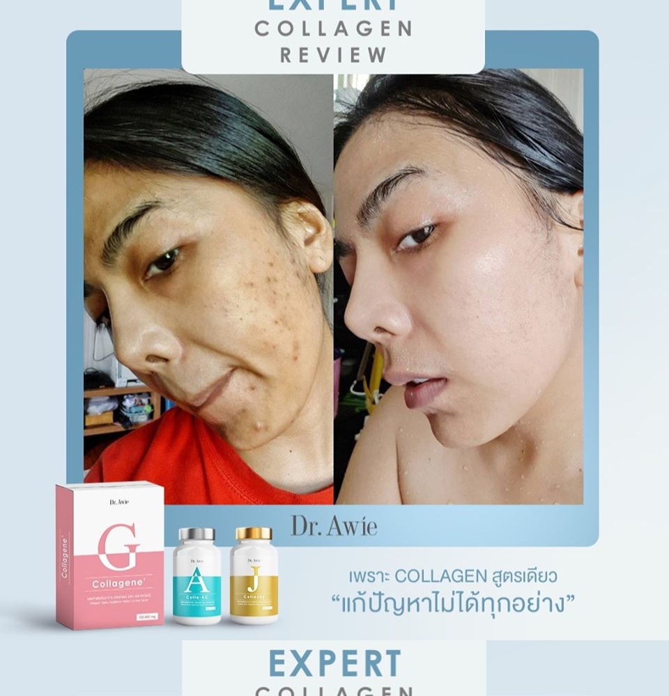 ภาพประกอบของ SET คอลลาเจนลดสิวผิวใส [ของแท้ ส่งฟรี ] Dr.awie Colla-AC คอลาเจนแก้สิว *ของแท้ ส่งฟรี* คอลลาเจนญี่ปุ่น คอลลาเจนลดสิว โดยหมอผึ้ง [ 2 กระปุก 1 กล่อง ]